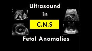 Ultrasound in CNS foetal anomalies [upl. by Eile]