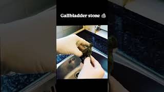 Gall bladder stonemedical shorts youtubeshorts motivation ytshorts viralshorts [upl. by Lopes498]