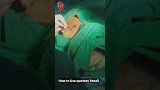 Pencil used in surgery pencil use inPPI pacemaker cathlab [upl. by Lamok30]