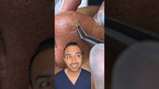 OMG I was not expecting that blackhead extraction on the nose Dr Somji reacts [upl. by Eiblehs945]