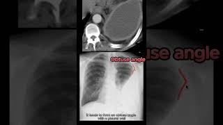 Empyema vs Pleural Effusion vs Lung Abscess radiology radiologystudent medicalstudent [upl. by Joby]