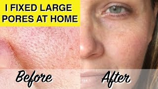 DIY LARGE PORES TREATMENT At Home Glycolic Acid Peel Dramatically Reduces Pores amp Wrinkles [upl. by Parnell]