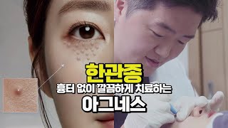 한관종 흉터없이 다음날 세안이 가능한 아그네스치료 ｜탄산가스레이저와 차이점 [upl. by Milano]