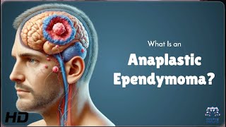 Anaplastic Ependymoma Explained Symptoms Treatment and Hope [upl. by Yazbak280]