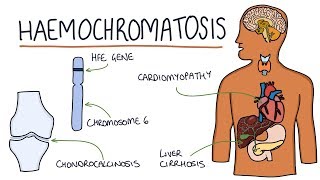 Understanding Haemochromatosis [upl. by Travax]