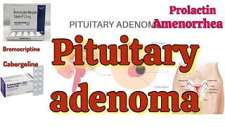 Pituitary adenoma  gynic case20 [upl. by Ullyot84]