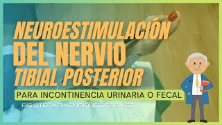 👌 Neuroestimulación del nervio TIBIAL POSTERIOR para INCONTINENCIA URINARIA o FECAL [upl. by Quintina]