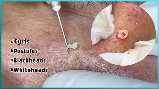 Big Cystic Acne Blackheads Extraction Blackheads amp Milia Whiteheads Removal Pimple Popping [upl. by Allveta]