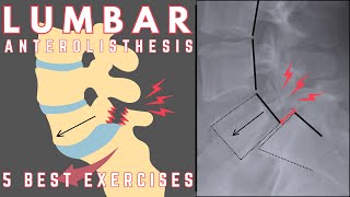 Best Exercises for Lumbar Anterolisthesis  Relieve Lower Back Pain  Dr Jon Saunders [upl. by Adiaroz]