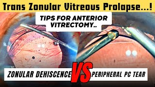 Trans Zonular Vitreous Prolapse Tips for AntVitrectomy Zonular Dehiscence VS Peripheral PC tear [upl. by Ellenwahs]