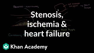 Stenosis ischemia and heart failure  Miscellaneous  Heatlh amp Medicine  Khan Academy [upl. by Eirrak]