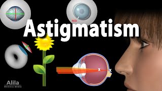 Astigmatism Types Causes Symptoms and Treatment Options Animation [upl. by Gyasi]