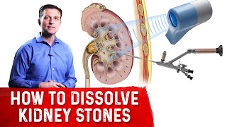 How To Dissolve Kidney Stones Explained By DrBerg [upl. by Leterg636]