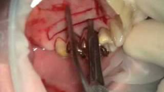 Gingival Grafting [upl. by Vanni]