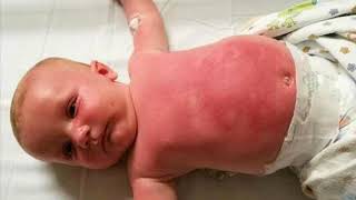 baby powder and oil cause cancer [upl. by Riehl387]