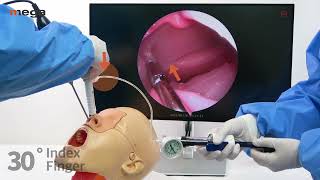 Navilloone  Balloon Eustachian Tube Dilation Tips for use [upl. by Oidgime8]