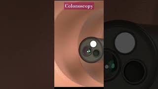 Colonoscopy humananatomy nursingstudent science humanbody nursing mbbs shortvideo [upl. by Nymrak]