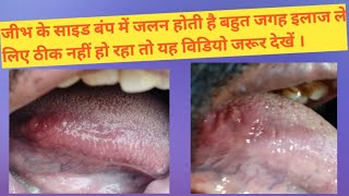 Tongue Side bump burning Tongue Papillae swellingMy back side of Tongue papillae has pain burning [upl. by Adnilam]