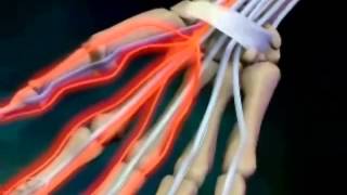 Difference between tendonitis and carpal tunnel [upl. by Ztnaj]