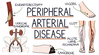 Understanding Peripheral Arterial Disease [upl. by Kenway]