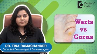 WARTS vs CORNS  Difference amp Treatment  DrTina Ramachander Doctors Circle [upl. by Sigismund175]