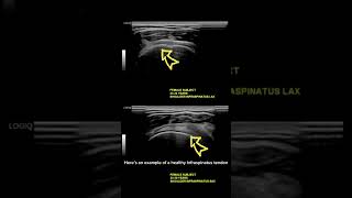 ultrasound Guided Interventions Healthy Images Infraspinatus Tendon [upl. by Roger]