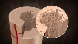 What causes Osteoporosis [upl. by Nivrac396]