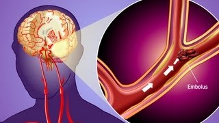 Stroke Prevention amp Transient Ischemic Attack TIA [upl. by Ecnadnac]