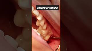 Surgical extraction of impacted wisdom tooth wisdomtoothremoval [upl. by Sells]