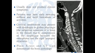 Diffuse Idiopathic Skeletal Hyperostosis DISH [upl. by Nomolos917]