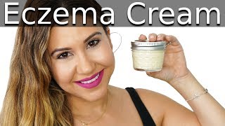 DIY Eczema Cream  Itchy Skin Relief [upl. by Yffat194]