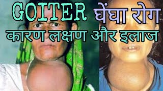 Goiter treatment symptoms cause in hindi [upl. by Letniuq]