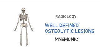 Well defined osteolytic lesions [upl. by Anihtyc671]