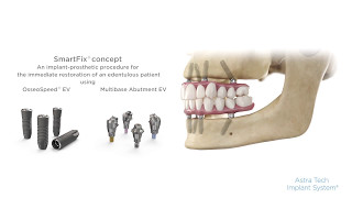 Stepbystep procedure SmartFix® concept for Astra Tech Implant System® EV  Dentsply Sirona [upl. by Mena16]