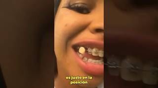 ¿Puedo usar dientes provisionales con brackets Aquí tiene la respuesta [upl. by Dean]