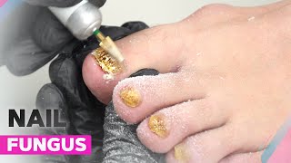 Onychomycosis  How to Deal with Nail Fungus [upl. by Ynobe836]