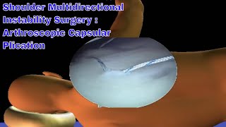 Arthroscopic Multidirectional Instability Shoulder Surgery  Dont Let Your Shoulder Pain Win [upl. by Aram]