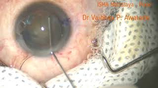 Phaco  Direct Chop  Toric Multifocal IOL  101124 [upl. by Suissac55]