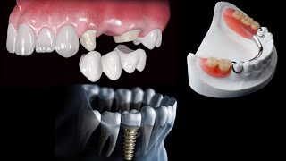 Como Recolocar Dentes Perdidos  Implantes Dentários e Próteses Dentárias [upl. by Fayette561]