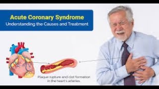 ESC GUIDELINES ON ACUTE CORONARY DISEASEWACP [upl. by Cleo]