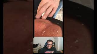 Gushing Back Cyst Pop pimple pimplepop blackhead whitehead shorts [upl. by Ylek]