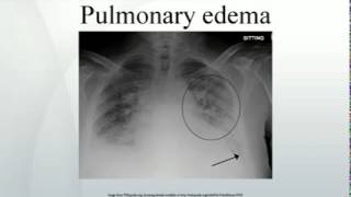 Pulmonary edema [upl. by Ylrahc516]