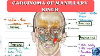 ENT 🔥 II CARCINOMA OF MAXILLARY SINUS II OHNGRENS LINE II LEDERMANS CLASSIFICATION II TNM STAGING [upl. by Aliemaj]