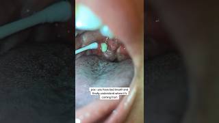 How You Are Removing Tonsil Stones The WRONG Way 😳🪥 [upl. by Huldah]