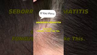 Seborrheic Dermatitis How to treat your Scalp itchyscalp shorts dandruff seborrheicdermatitis [upl. by Pepita]