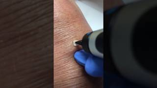 Wratjes verwijderen met cryopen [upl. by Lash]