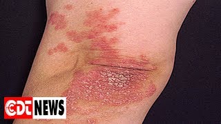 Psoriasis les meilleurs remèdes naturels  CDT NEWS [upl. by Edya885]