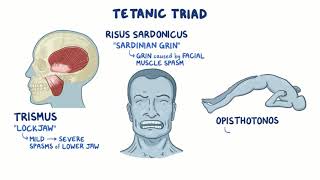 Clostridium tetani tetanus causes symptoms diagnosis treatment pathology [upl. by Luane401]