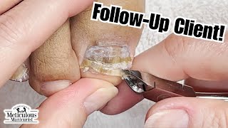 Best Toenail Cleaning on YouTube nails satisfying [upl. by Alick]