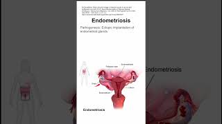 Endometriosis [upl. by Aldis487]